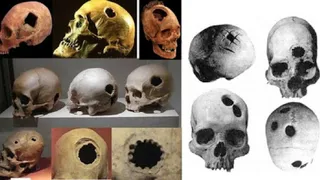 В Китае выставили на всеобщее обозрение черепа древних людей с отверстиями – следами трепанации