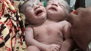 В  Бангладеш родился двухголовый ребенок