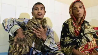 На Земле объявился еще один «человек-дерево» 